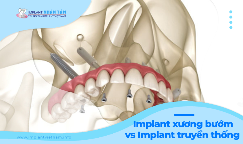 Sự khác biệt giữa Implant xương bướm và Implant truyền thống