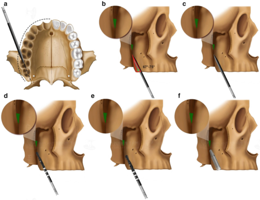 Cấy ghép Implant xương bướm mang lại nhiều lợi ích như giảm xâm lấn, rút ngắn thời gian điều trị…