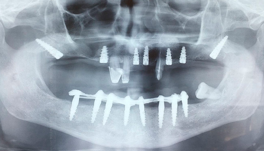 Implant xương bướm được đặt tại vùng xương cánh bướm