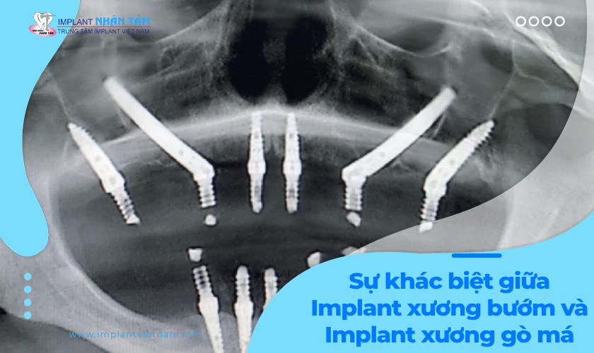 Sự khác biệt giữa Implant xương bướm và Implant xương gò má