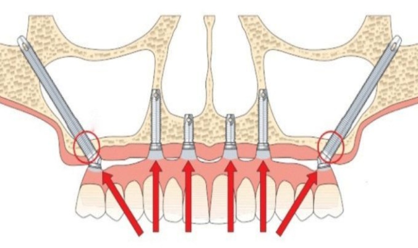 Cấy ghép Implant xương gò má