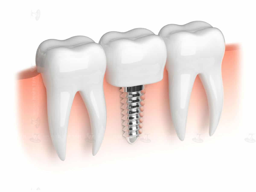 Răng Implant có cả chân răng và thân răng