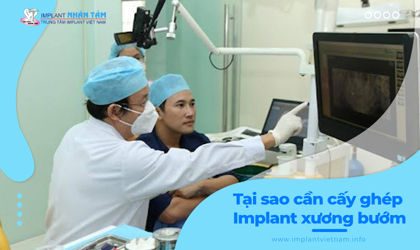 Tại sao nên cấy ghép Implant chân bướm?