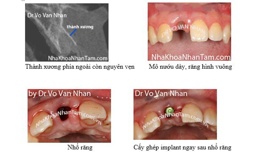 Cấy Implant tức thì ngay sau nhổ răng