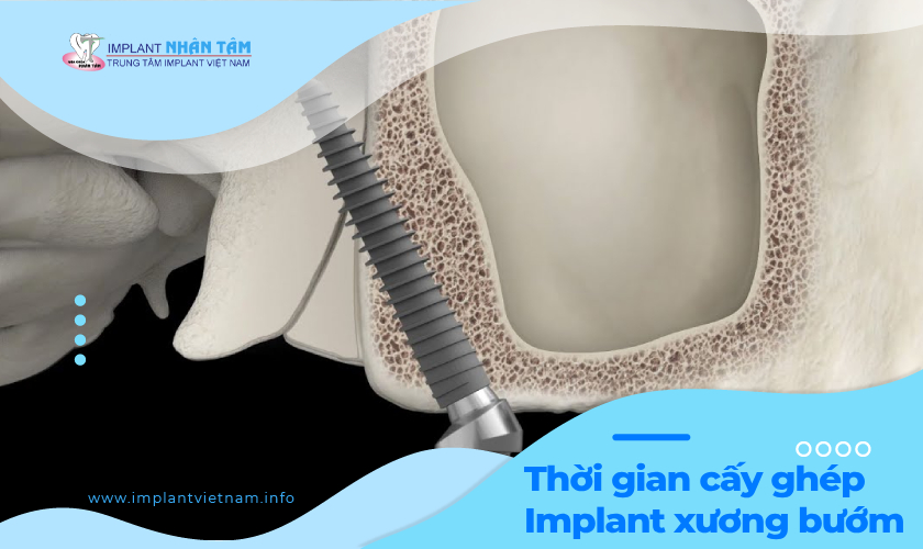 Thời gian thực hiện cấy ghép Implant xương bướm