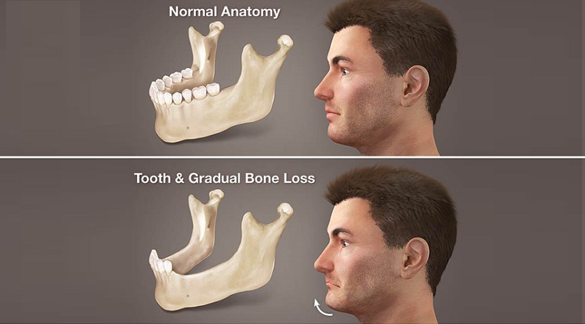 Tình trạng tiêu xương hàm sẽ khiến thời gian trồng răng Implant kéo dài hơn