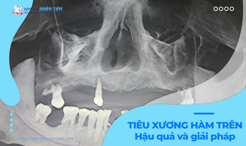 Tiêu xương hàm trên - Hậu quả và giải pháp