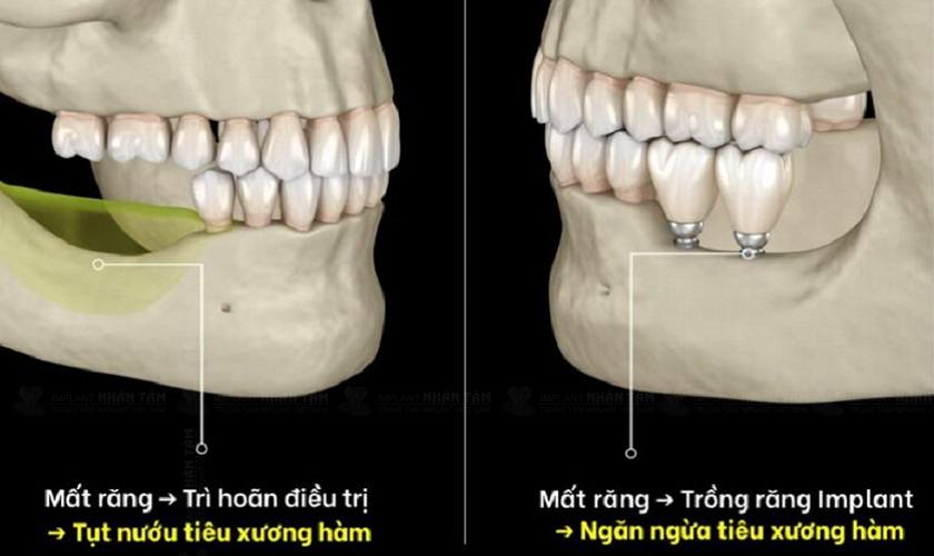 Trồng răng Implant giúp ngăn ngừa hiệu quả tình trạng tiêu xương hàm do mất răng gây ra