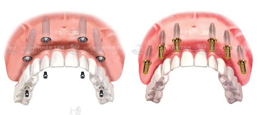 Implant MIS C1 được đánh giá cao trong khôi phục răng toàn hàm với giải pháp Implant All On X