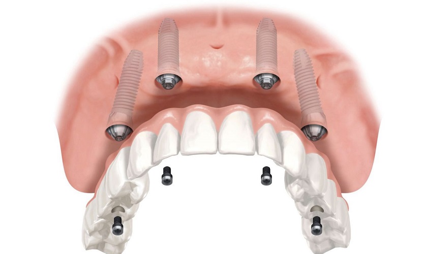 Trồng răng Implant All on 4 là gì? Giá bao nhiêu?