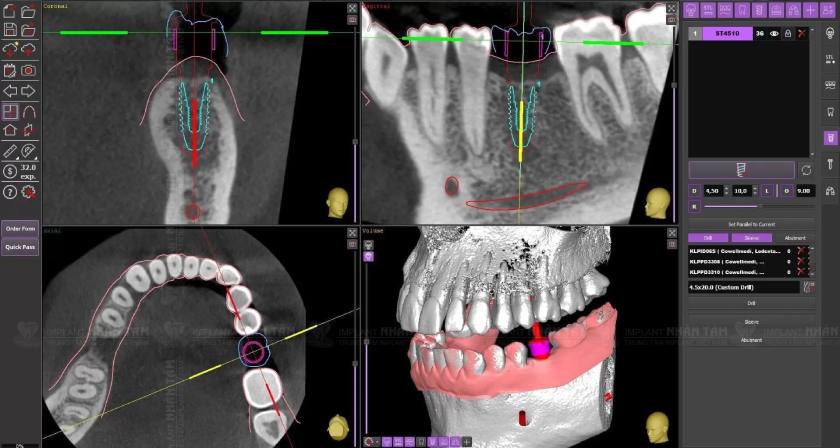 Máng hướng dẫn phẫu thuật cấy ghép Implant cho phép hỗ trợ Bác sĩ lên kế hoạch điều trị