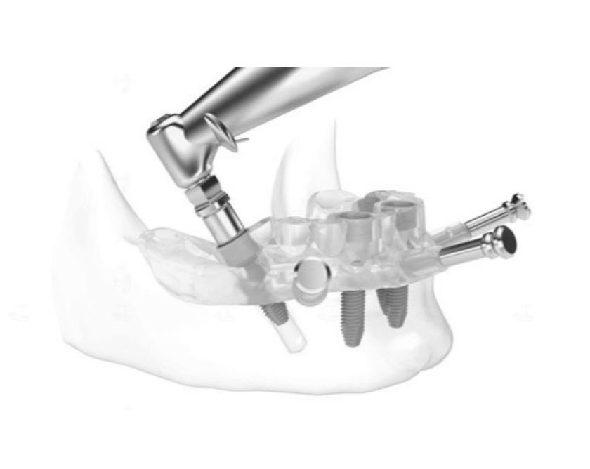 Máng hướng dẫn phẫu thuật giúp định hình vị trí cấy trụ Implant, rút ngắn thời gian thực hiện phẫu thuật