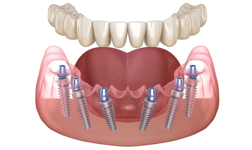 Ưu điểm của trồng răng bằng cấy ghép Implant