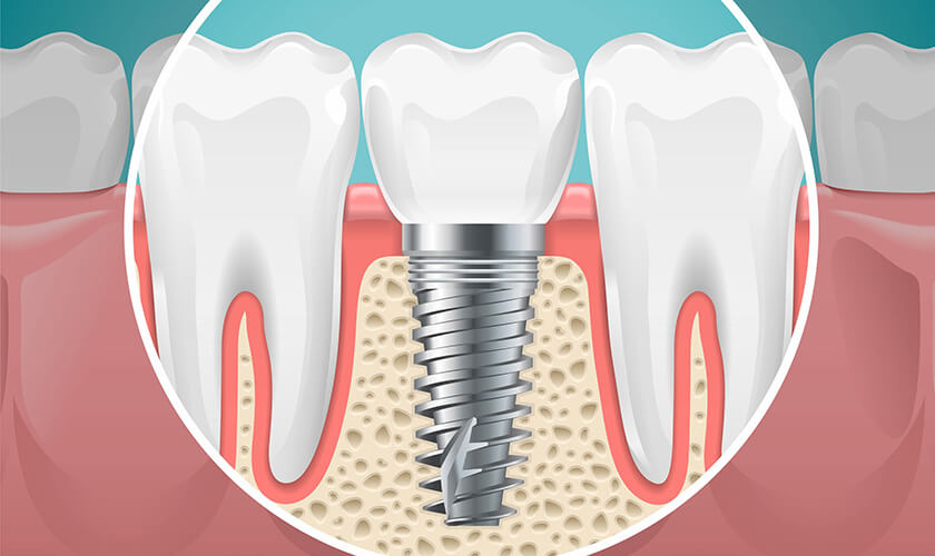Trồng răng bằng cấy ghép implant có thật sự tốt?