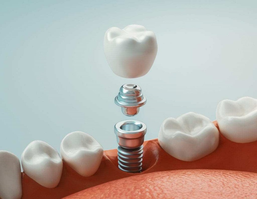 Tiến hành gắn răng sứ lên trụ implant