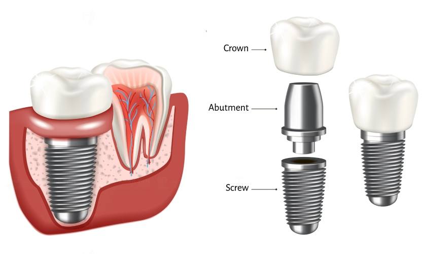 Cấu tạo hoàn chỉnh của răng Implant