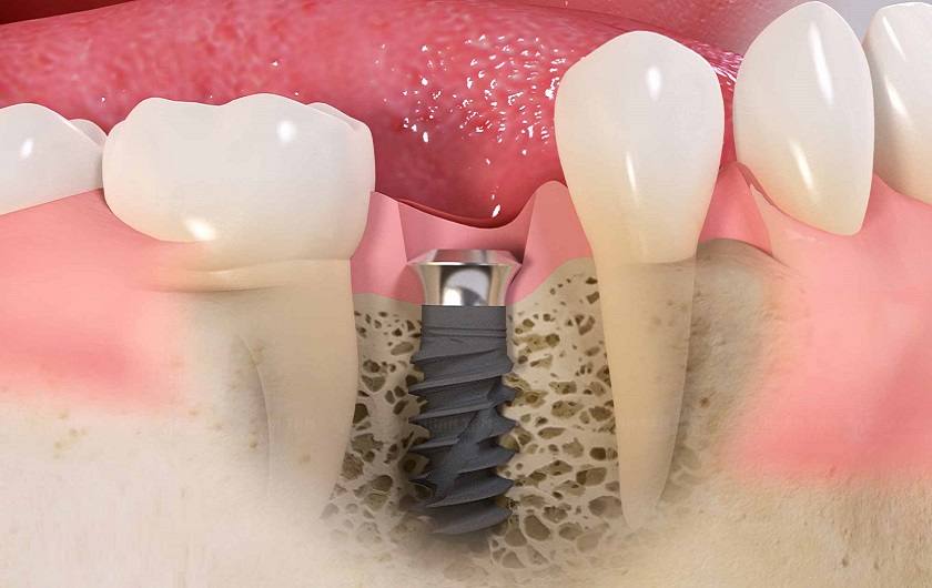 Trồng răng Implant giúp phục hình răng mất tối ưu, cải thiện ăn nhai và nâng cao thẩm mỹ hiệu quả