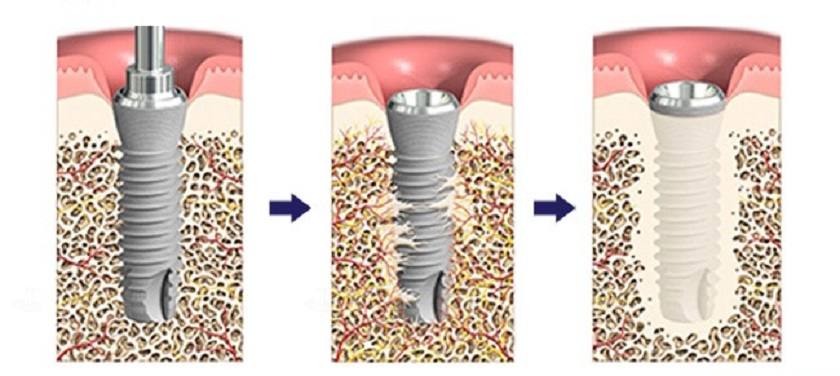 Chọn trụ Implant có khả năng tích hợp xương tốt