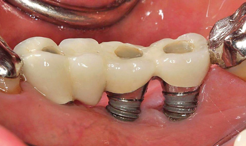 Trồng răng implant tại địa chỉ kém uy tín có thể dẫn đến những biến chứng nguy hiểm