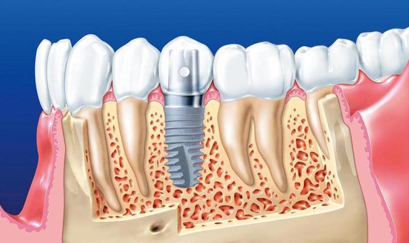 Trồng răng Implant giá bao nhiêu 1 cái?