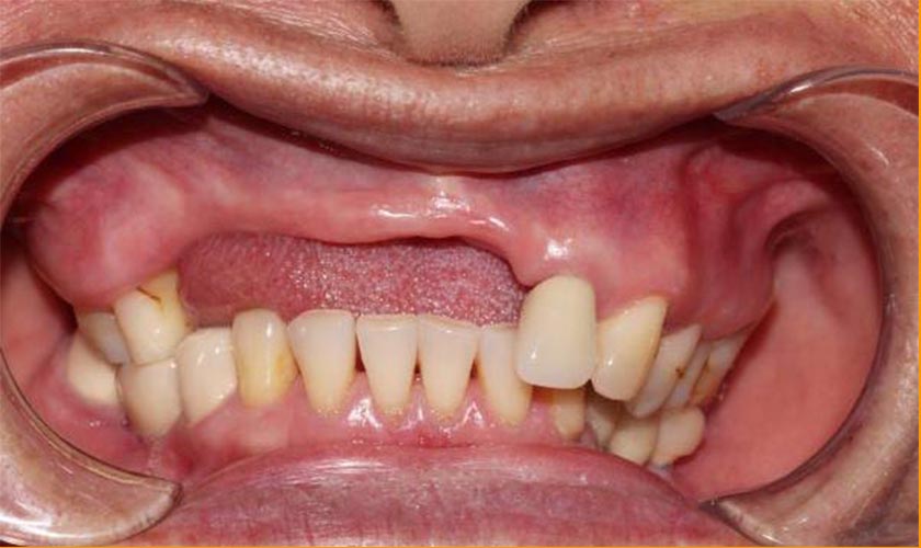 Hình ảnh minh họa tiêu xương do mất răng