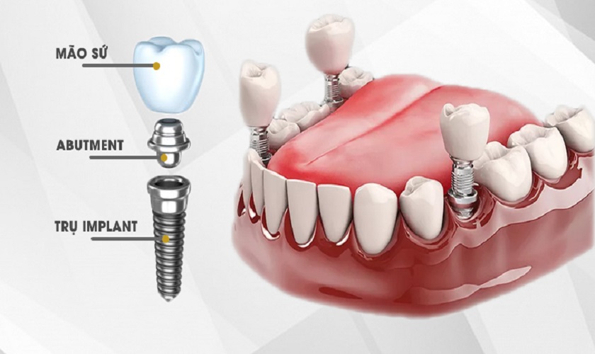 Trồng răng implant là gì? Những lưu ý khi trồng răng implant