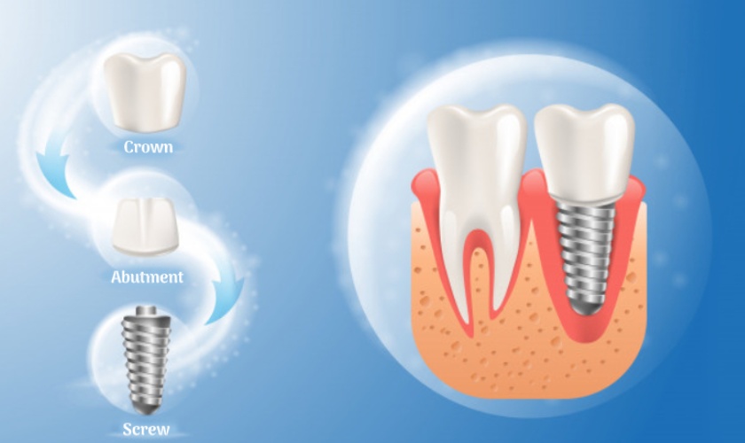 Trồng răng implant là gì? Được thực hiện như thế nào?