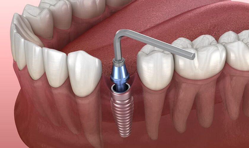 Trồng răng implant là giải pháp được đánh giá cao nhất hiện nay