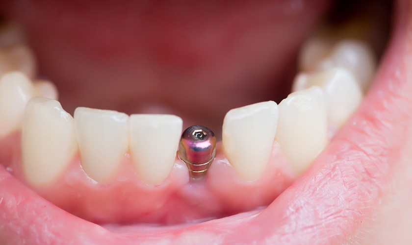 Trồng răng implant là gì? Tuổi thọ bao lâu? Loại nào tốt?