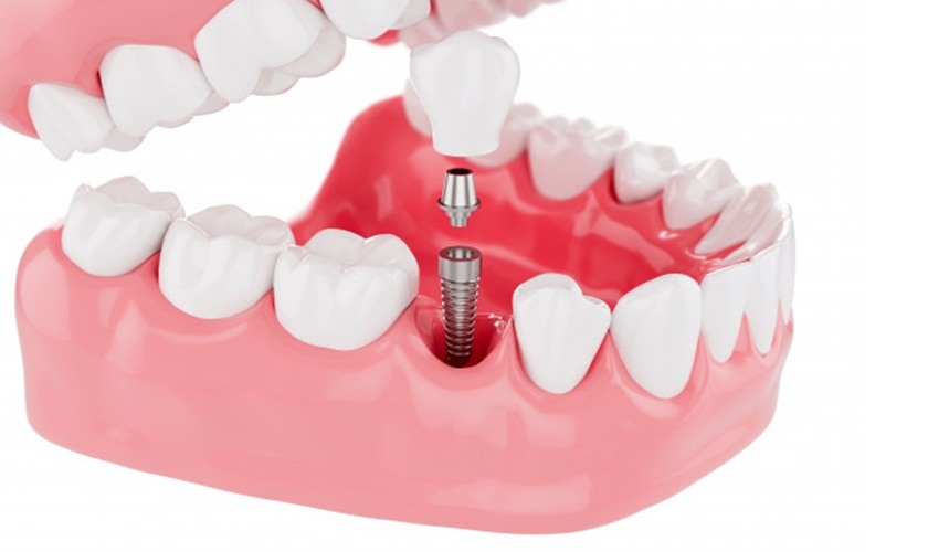 Trồng răng implant ở đâu tốt TPHCM? 