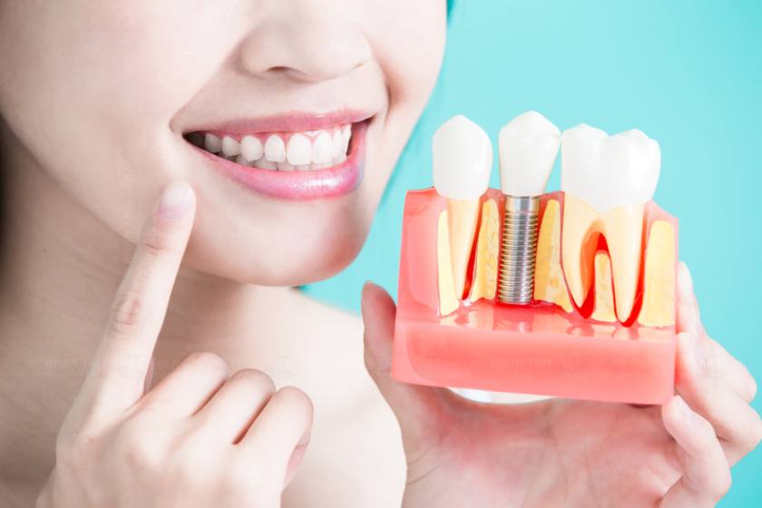 Trụ Implant Biotem đến từ thương hiệu Biotem nổi tiếng của Hàn Quốc