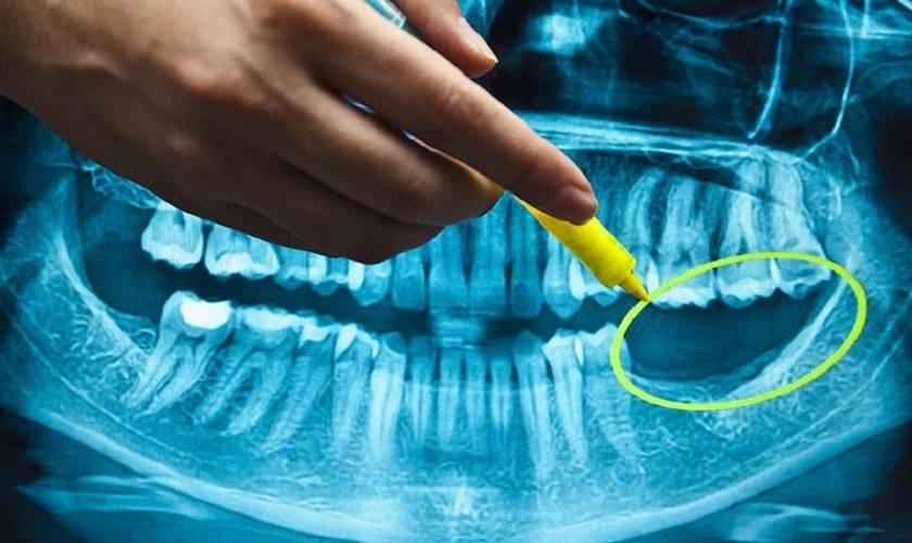 Trụ Implant Biotem không phải là dòng trụ phù hợp có bệnh nhân có xương hàm yếu