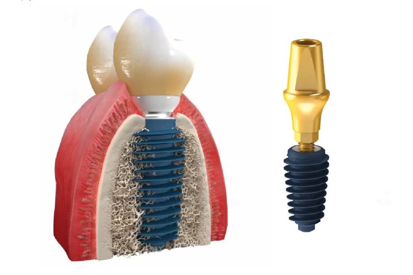 Trụ Implant Megagen Hàn Quốc cũng là dòng trụ Implant được nhiều Khách hàng lựa chọn