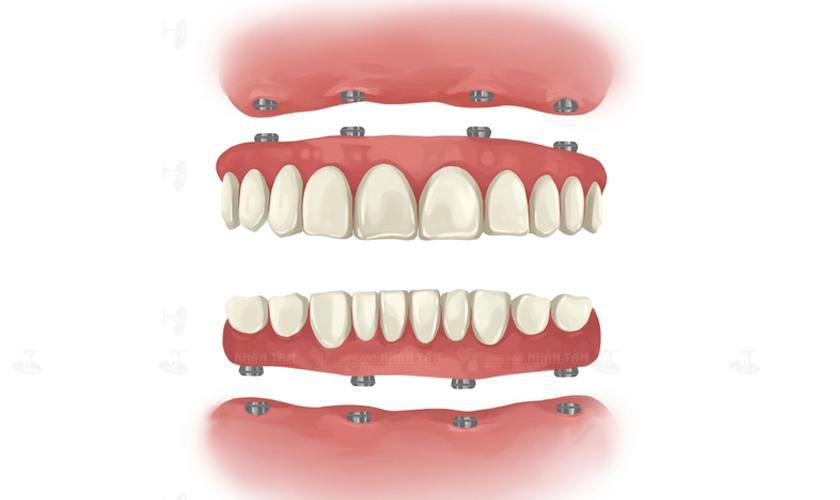 Trụ Implant Nobel TiUltra được ứng dụng trong tất cả các trường hợp mất răng, đặc biệt hiệu quả cho giải pháp phục hồi răng mất toàn hàm Implant All on X