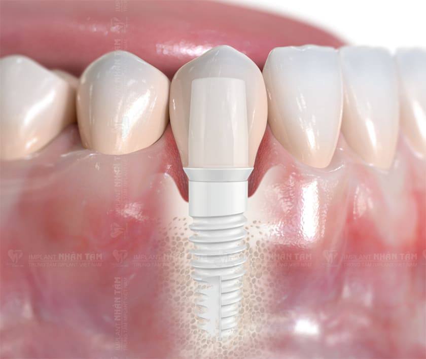 Implant Nobel TiUltra với cấu tạo thông minh tối ưu hóa lợi ích cấy ghép răng