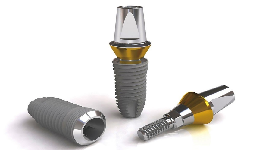 Chi phí của trụ Implant Nobel TiUltra hiện tại đang ở phân khúc cao hơn so với các dòng trụ Implant khác, tuy nhiên với nhiều lợi ích vượt trội, loại trụ này sẽ giúp bệnh nhân tiết kiệm chi phí trong tương lai