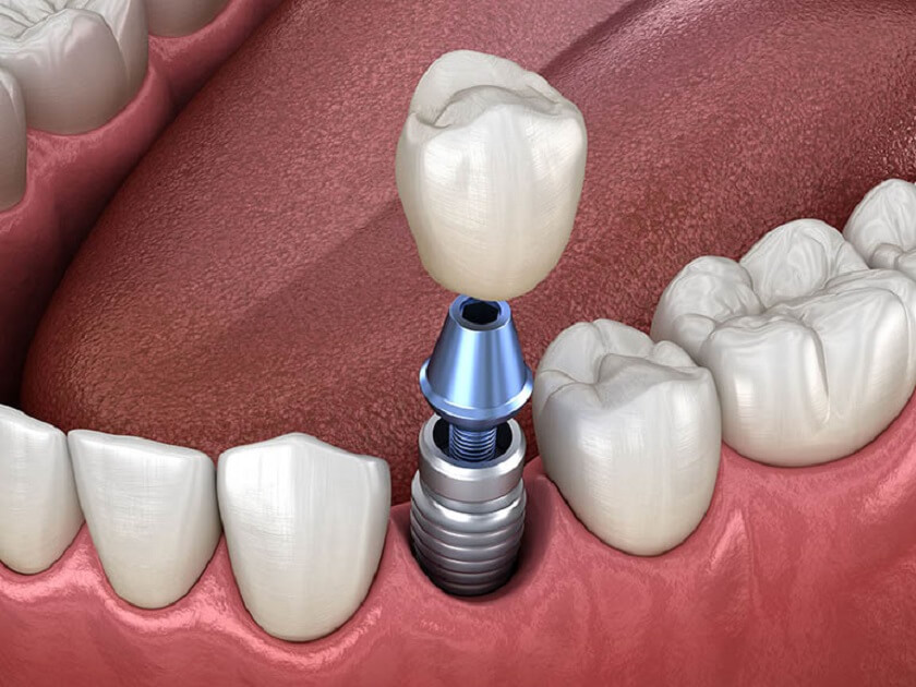 Gắn răng sứ sau 4 đến 6 tuần đặt Implant