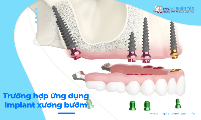 Trường hợp ứng dụng Implant xương bướm