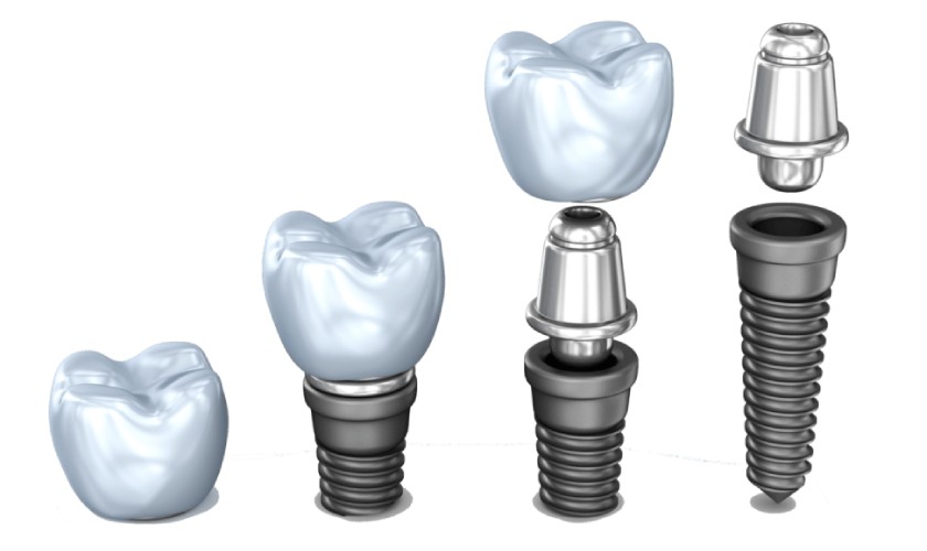 Giá răng implant được tính dựa trên chất lượng trụ implant, abutment, răng sứ