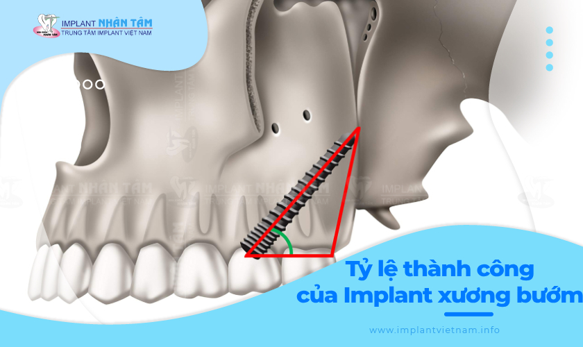 Tỷ lệ thành công của cấy ghép Implant xương bướm