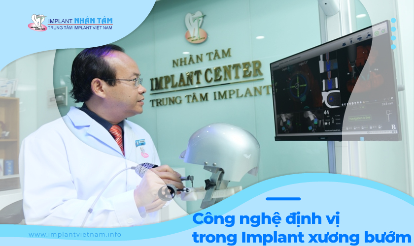 Ứng dụng công nghệ định vị trong Implant xương bướm