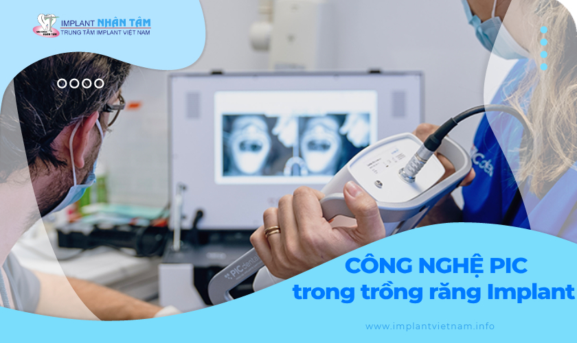 Ứng dụng công nghệ PIC trong trồng răng Implant