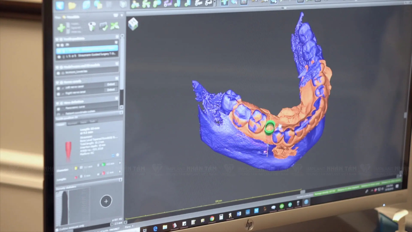 Thiết kế mô hình phục hình răng trên Implant