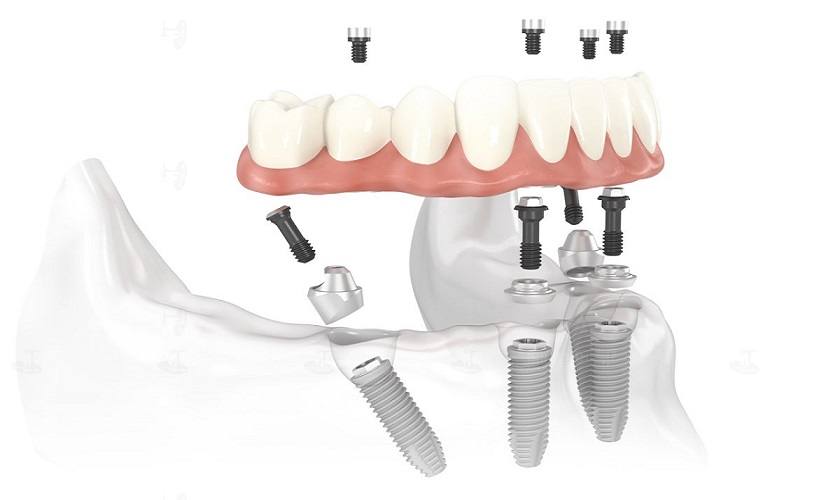 Trồng răng Implant All On 4 trên khung BioHPP là phương pháp cấy 4 trụ Implant vào xương hàm theo hướng thuận lợi