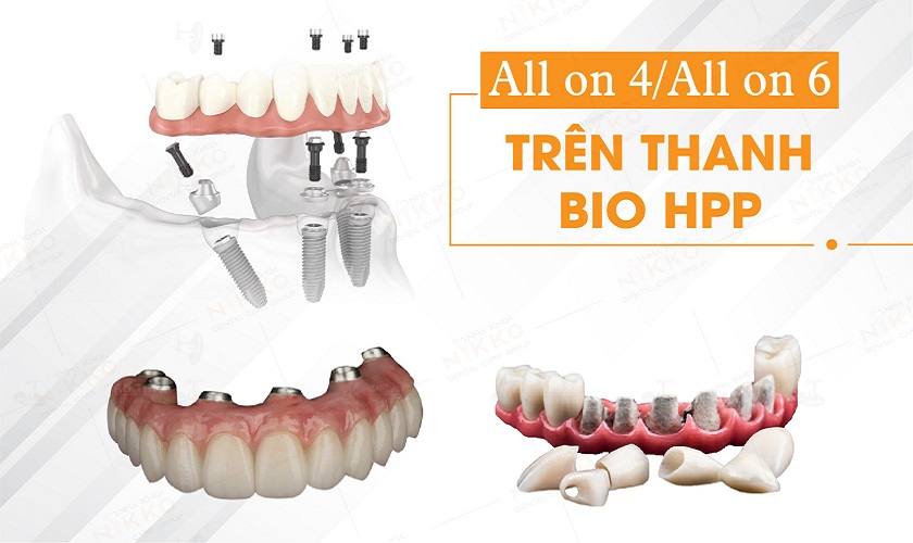 Phục hình Implant All on 4/ All on 6 trên thanh Bar làm từ vật liệu sườn sinh học BioHPP giúp giảm thiểu tối đa áp lực lên trụ Implant, tạo cảm giác thoải mái khi ăn nhai cho Khách hàng