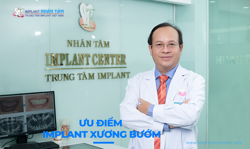 Ưu điểm của cấy ghép Implant xương bướm