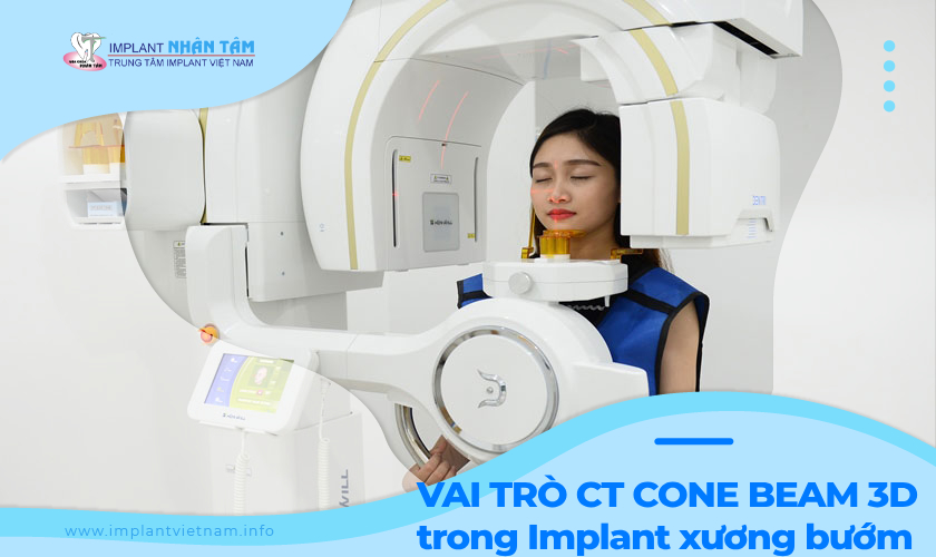 Vai trò của CT Cone Beam 3D trong Implant xương bướm