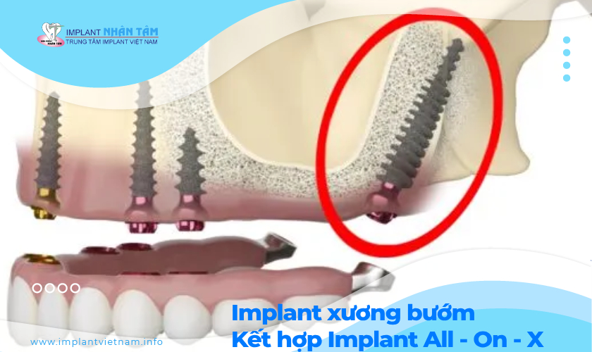 Vai trò Implant xương bướm trong quy trình Implant ALL - On 