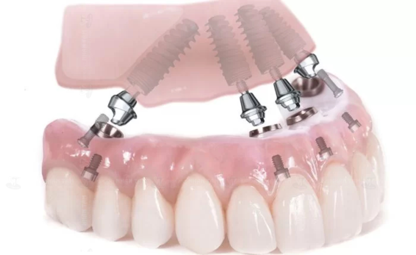 Implant All – On – X cung cấp một giải pháp bền vững với chi phí tiết kiệm cho bệnh nhân mất răng toàn hàm