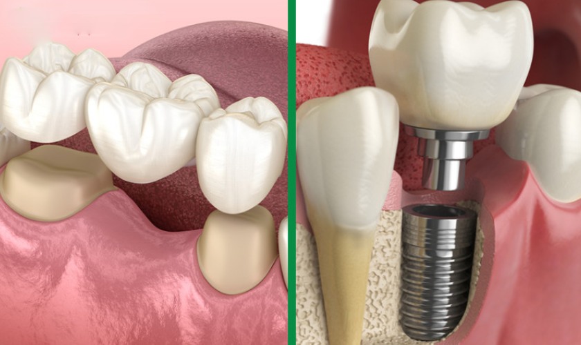 Nên làm cầu răng sứ hay trồng răng implant là thắc mắc của rất nhiều người